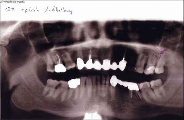 Verdacht auf Pulpitis