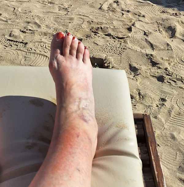 Sonnenbrand auf Fussrücken