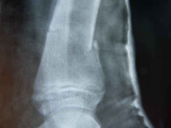 Skiunfall 3