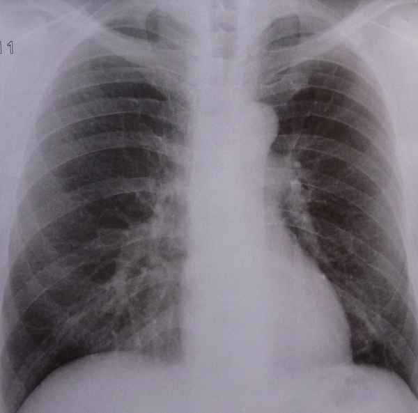 Thorax (Röntgen)