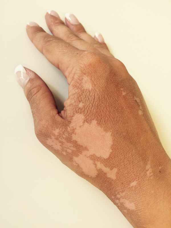 Hand Verbrennung