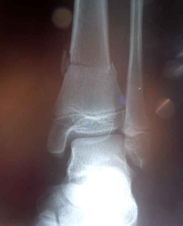 Skiunfall 4