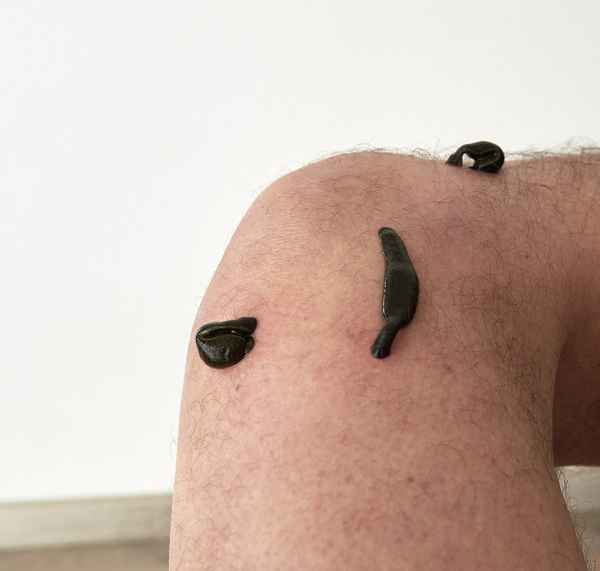 Blutegeltherapie