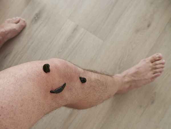 Blutegeltherapie