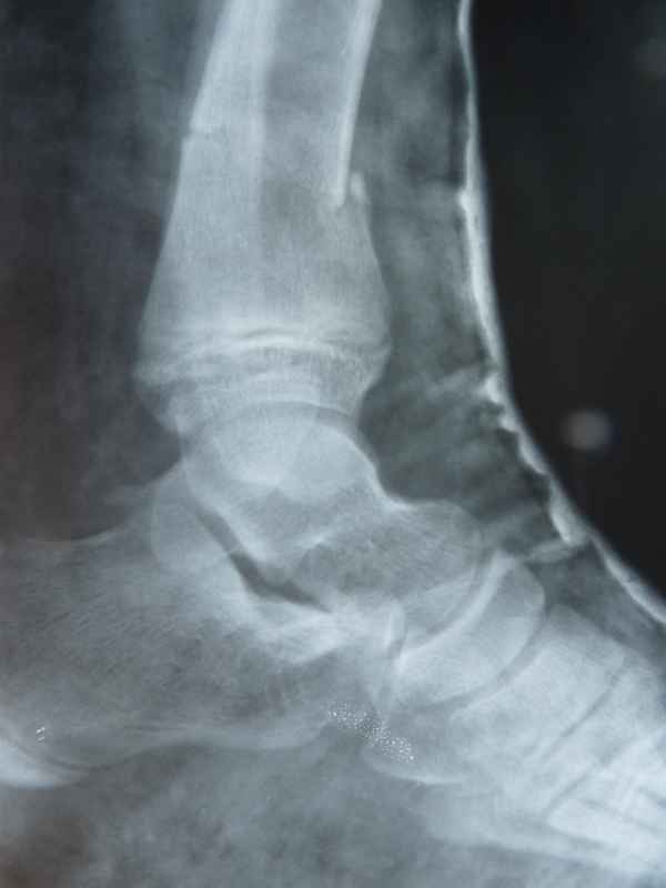 Skiunfall 1