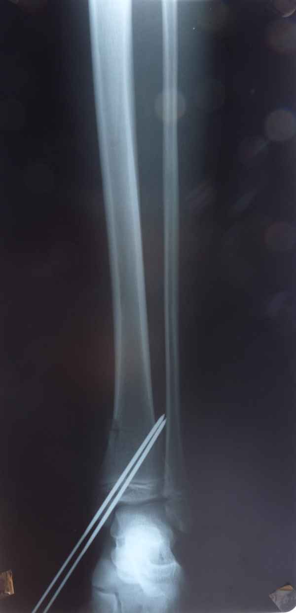 Skiunfall 6