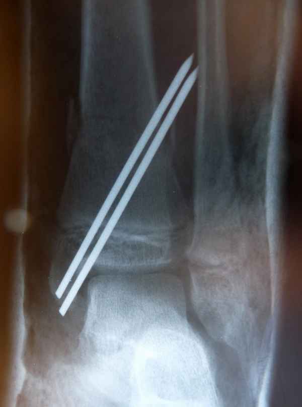 Skiunfall 6