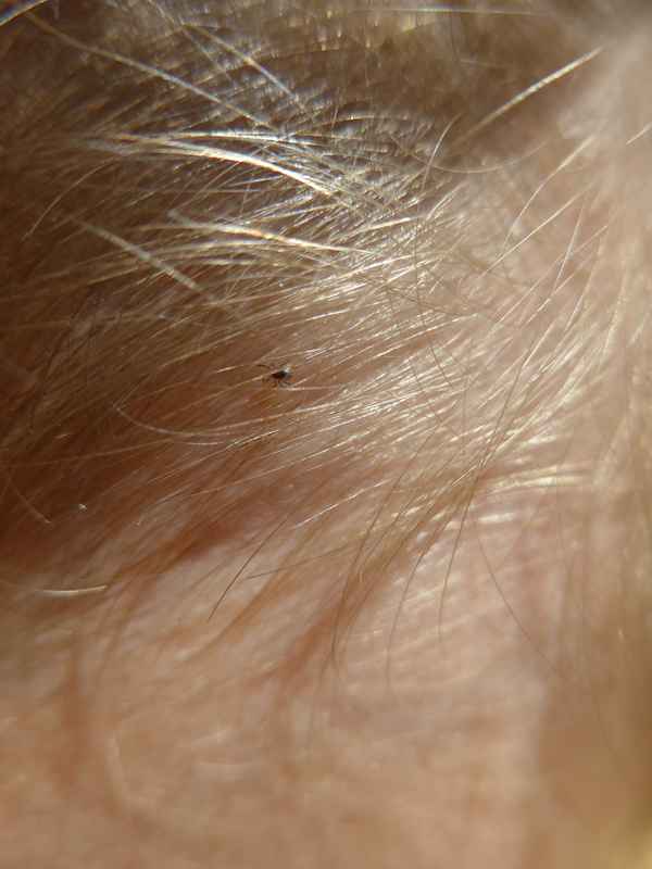 Vorsicht vor Zecken - Zecke im Haar