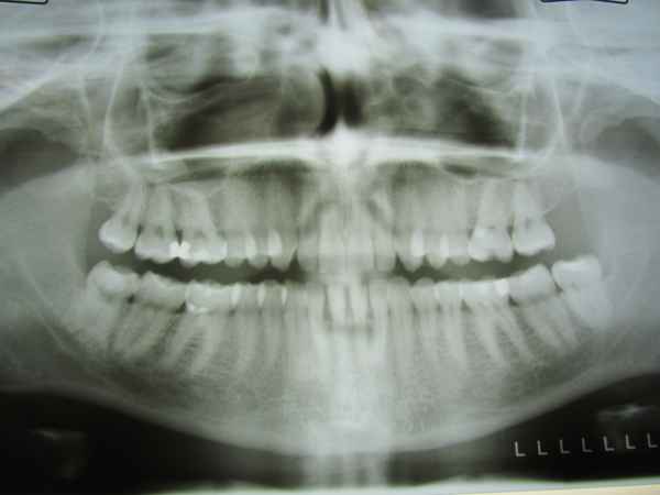 x-ray