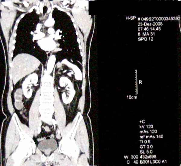Torax CT Computertomographie