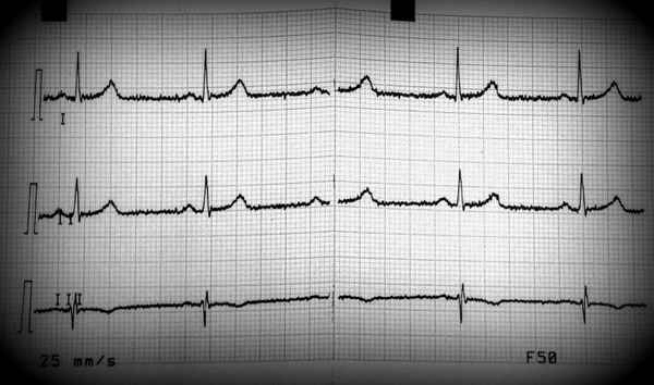 EKG 2