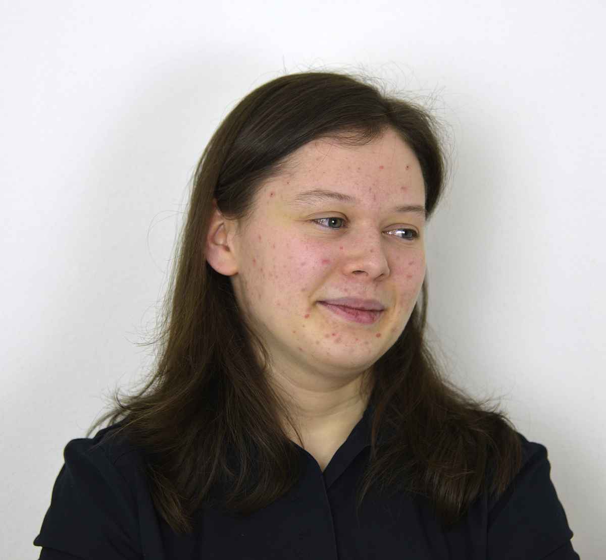 Pickelgesicht, junge Frau mit Akne