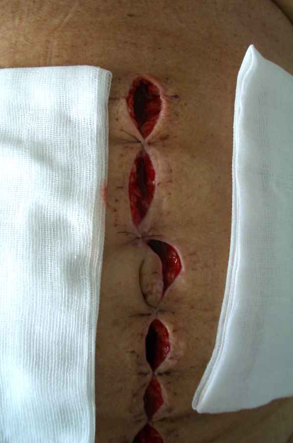 mein Bauch nach der vierten Operation