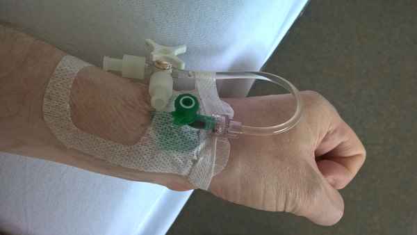 Venöser Zugang bei linker Hand