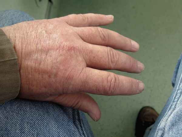 Angeschwollene Hand eines Herzkranken Mannes